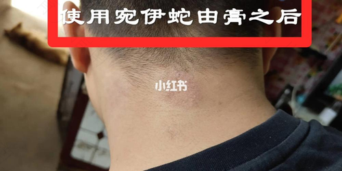 脖子上长藓怎么办? 脖子上长藓怎么办?