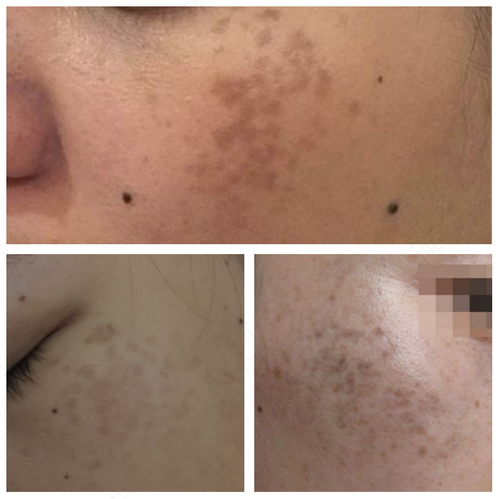 背上长黄褐斑是什么病