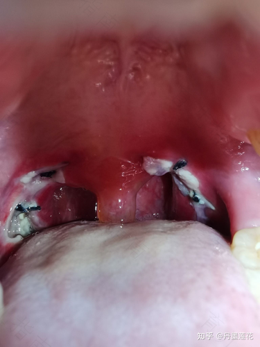 扁桃体长了一个白色的东西怎么办 扁桃体长了一个白色的东西怎么办