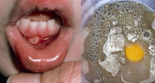 孩子嘴巴里面溃疡怎么办 孩子嘴巴里面溃疡怎么办