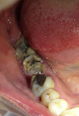 拔大牙有什么危害么 拔大牙有什么危害么