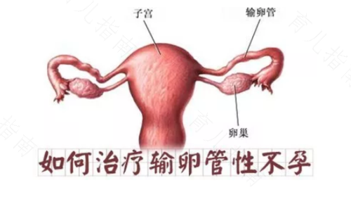 两侧输卵管堵塞怎么治疗 两侧输卵管堵塞怎么治疗