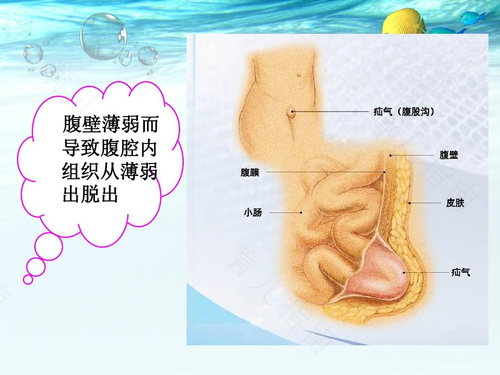 女生疝气做手术多久能下床 女生疝气做手术多久能下床