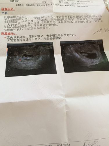 子宫疤痕憩室是什么意思 子宫疤痕憩室是什么意思