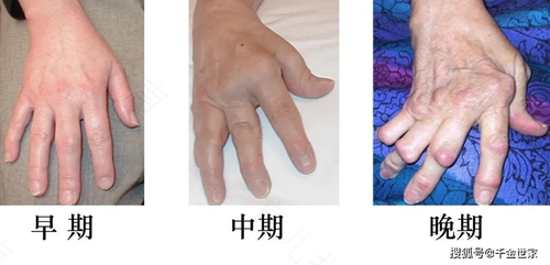 风湿和类风湿一样吗? 风湿和类风湿一样吗?