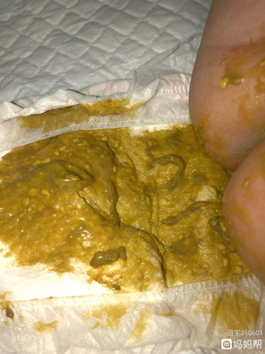 婴儿大便发青是怎么回事 婴儿大便发青是怎么回事