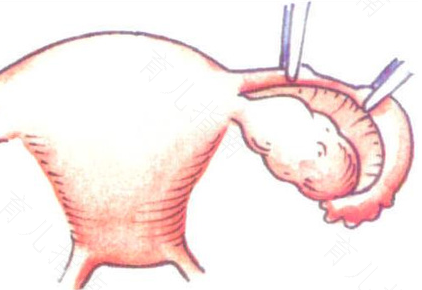 女人结扎对身体有什么伤害吗 女人结扎对身体有什么伤害吗