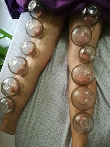 腰疼可以拔罐吗男 腰疼可以拔罐吗男