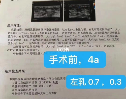 乳腺增生结节3类能自愈吗 乳腺增生结节3类能自愈吗