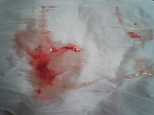 咳嗽喉咙痛咳出血丝怎么办 咳嗽喉咙痛咳出血丝怎么办