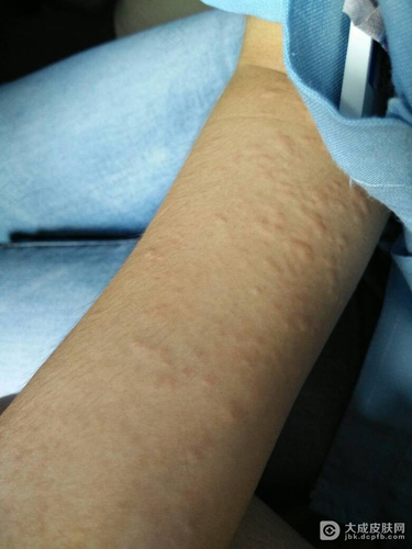 病毒性荨麻疹会传染吗 病毒性荨麻疹会传染吗