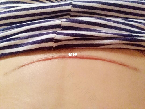 剖腹产伤口痒痒怎么办 剖腹产伤口痒痒怎么办