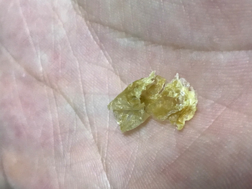 耳屎多久清理一次最好 耳屎多久清理一次最好