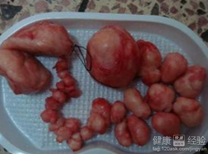 子宫肌瘤症状有哪些表现会疼? 子宫肌瘤症状有哪些表现会疼?