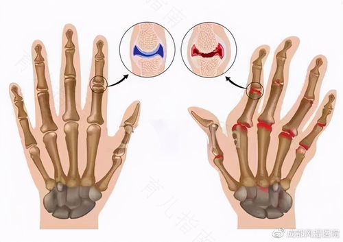 类风湿复发了怎么办
