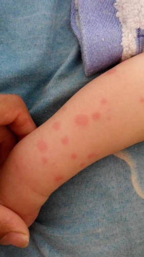 得了荨麻疹又发烧怎么办 得了荨麻疹又发烧怎么办