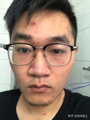 大人脸上出水痘怎么办 大人脸上出水痘怎么办