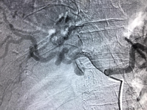 腹腔出血有什么症状 腹腔出血有什么症状