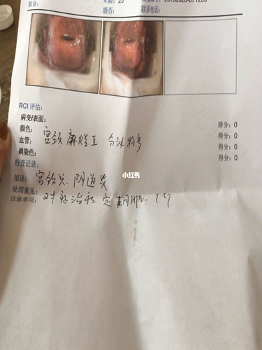 宫颈有鳞化是什么意思