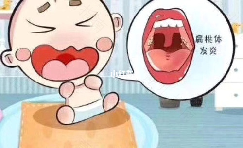 喉咙扁桃体疼怎么回事 喉咙扁桃体疼怎么回事