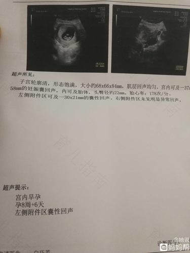 b超检查宫腔内有回声是什么意思 b超检查宫腔内有回声是什么意思