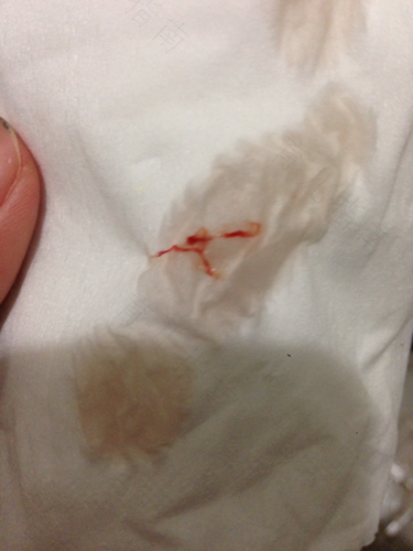 女生为什么拉尿会有血