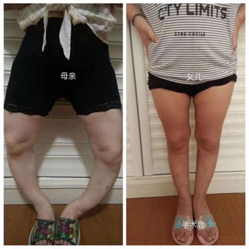 怎样预防o型腿或x型腿 怎样预防o型腿或x型腿