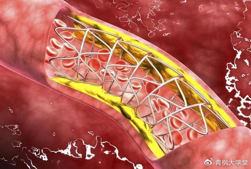 什么情况要做心脏支架手术