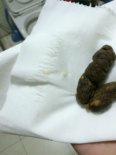 一岁宝宝拉白色大便怎么回事