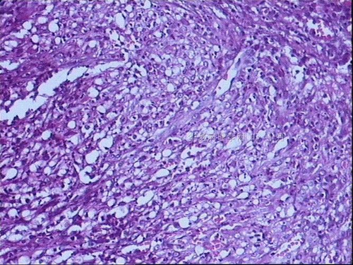 右侧输卵管囊肿是怎么造成的 右侧输卵管囊肿是怎么造成的