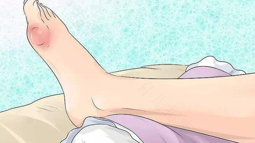 冰敷可以缓解痛风疼痛吗 冰敷可以缓解痛风疼痛吗