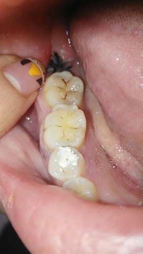 拔智齿还一直流血怎么办 拔智齿还一直流血怎么办