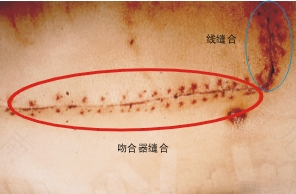 拆线后伤口没有愈合怎么办 拆线后伤口没有愈合怎么办