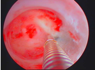 宫腔粘连为什么容易复粘 宫腔粘连为什么容易复粘