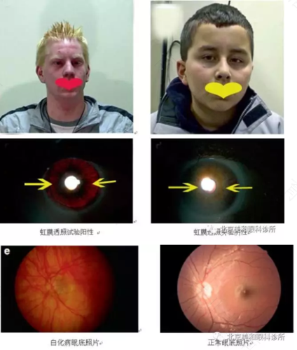 眼球震颤怎么治疗 眼球震颤怎么治疗