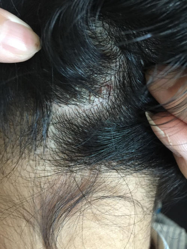 头顶头皮针刺的疼怎么回事 头顶头皮针刺的疼怎么回事