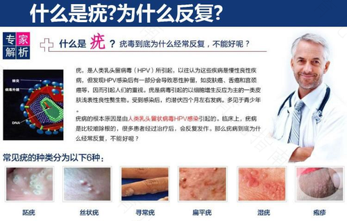 尖锐疣湿疹治疗要多长时间 尖锐疣湿疹治疗要多长时间
