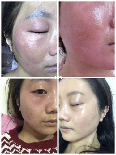 脸部过敏脸颊发红怎么办