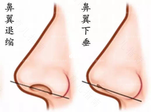 鼻翼肥厚的原因 鼻翼肥厚的原因