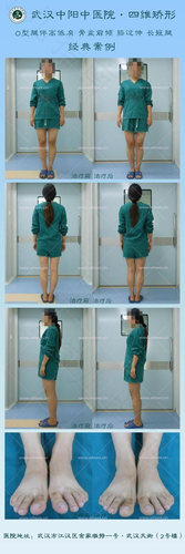 o型腿怎么锻炼矫正视频 o型腿怎么锻炼矫正视频