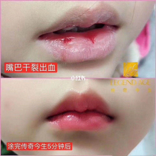 嘴巴一直脱皮干裂怎么办 嘴巴一直脱皮干裂怎么办