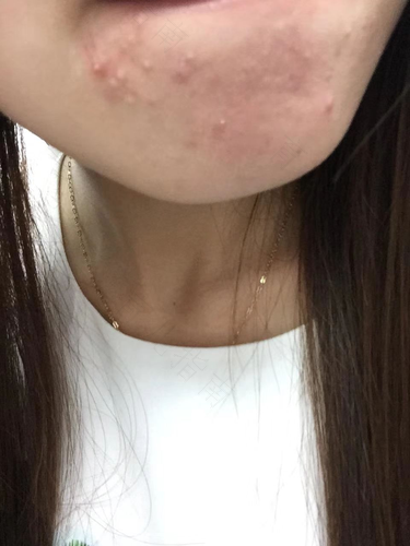 下巴周围长痘痘是妇科问题吗 下巴周围长痘痘是妇科问题吗