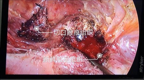 疤痕子宫憩室怎么治疗