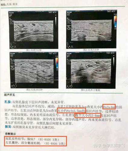 乳腺结节症状是什么情况 乳腺结节症状是什么情况