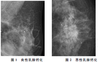 乳腺有钙化点怎么办 乳腺有钙化点怎么办