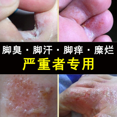 脚臭脚痒脚脱皮怎么办