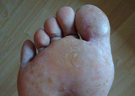 脚脱皮还会痒是什么原因 脚脱皮还会痒是什么原因