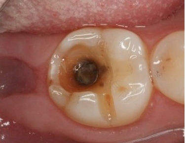 蛀牙补牙后牙齿酸痛怎么办 蛀牙补牙后牙齿酸痛怎么办