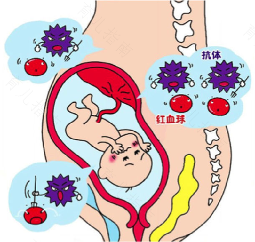溶血症可以治疗好吗 溶血症可以治疗好吗