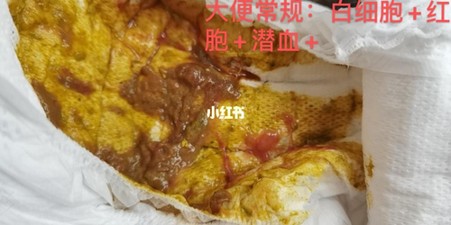 小肠结肠炎症状好转 小肠结肠炎症状好转